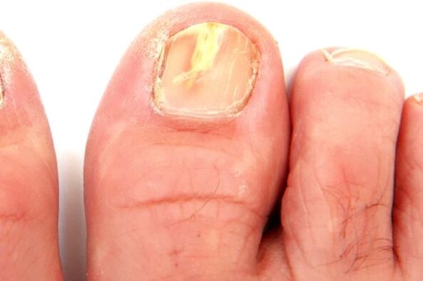 увреждане на нокътната плочка поради гъбична инфекция